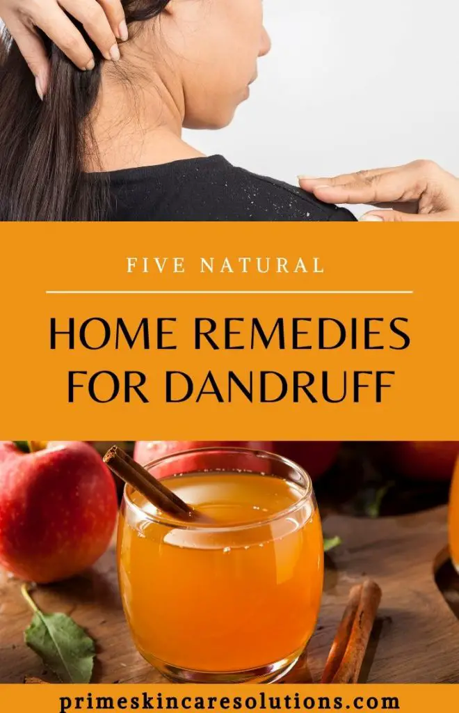 Natural home remedies for dandruff with recipes