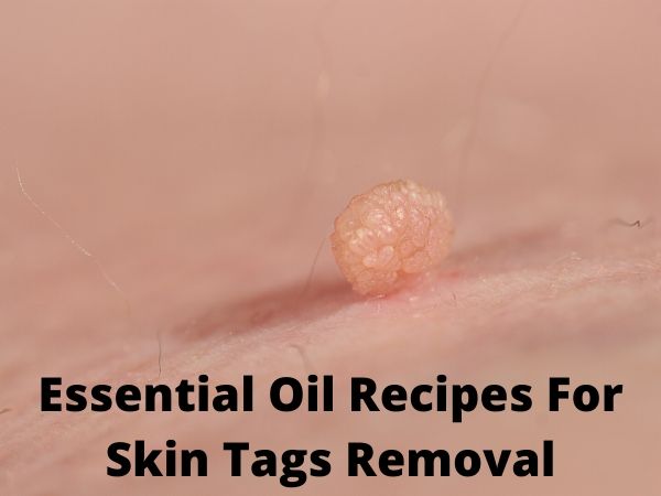 Essential Oils Recipes For Skin Tags Removal