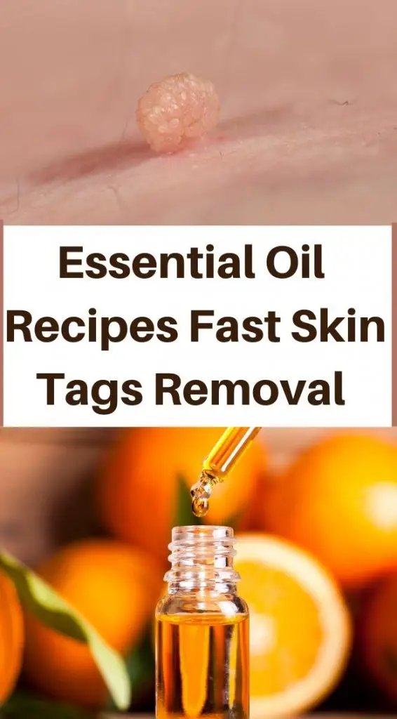 Essential Oils Recipes For fast Skin Tags Removal